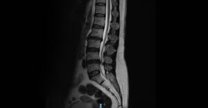 MRI scan showing a lumbar herniated disc causing nerve compression before non-surgical spinal decompression treatment in Henderson NV.