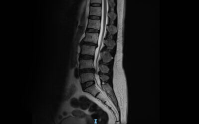 An MRI is Critical Before Spinal Decompression