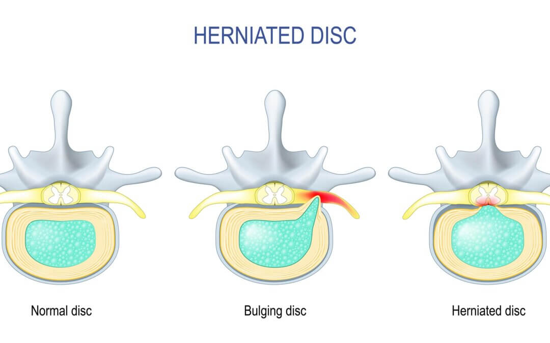 Bulging Disc: What It Is & Non-Surgical Treatment Options