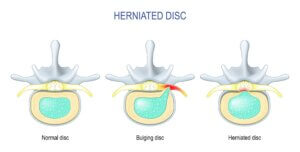 Bulging spinal disc compressing nerve with non-surgical treatment options illustrated