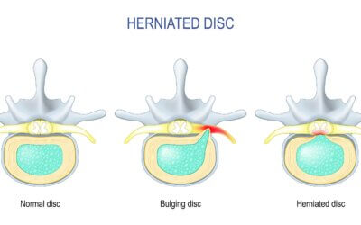 Bulging Disc: What It Is & Non-Surgical Treatment Options