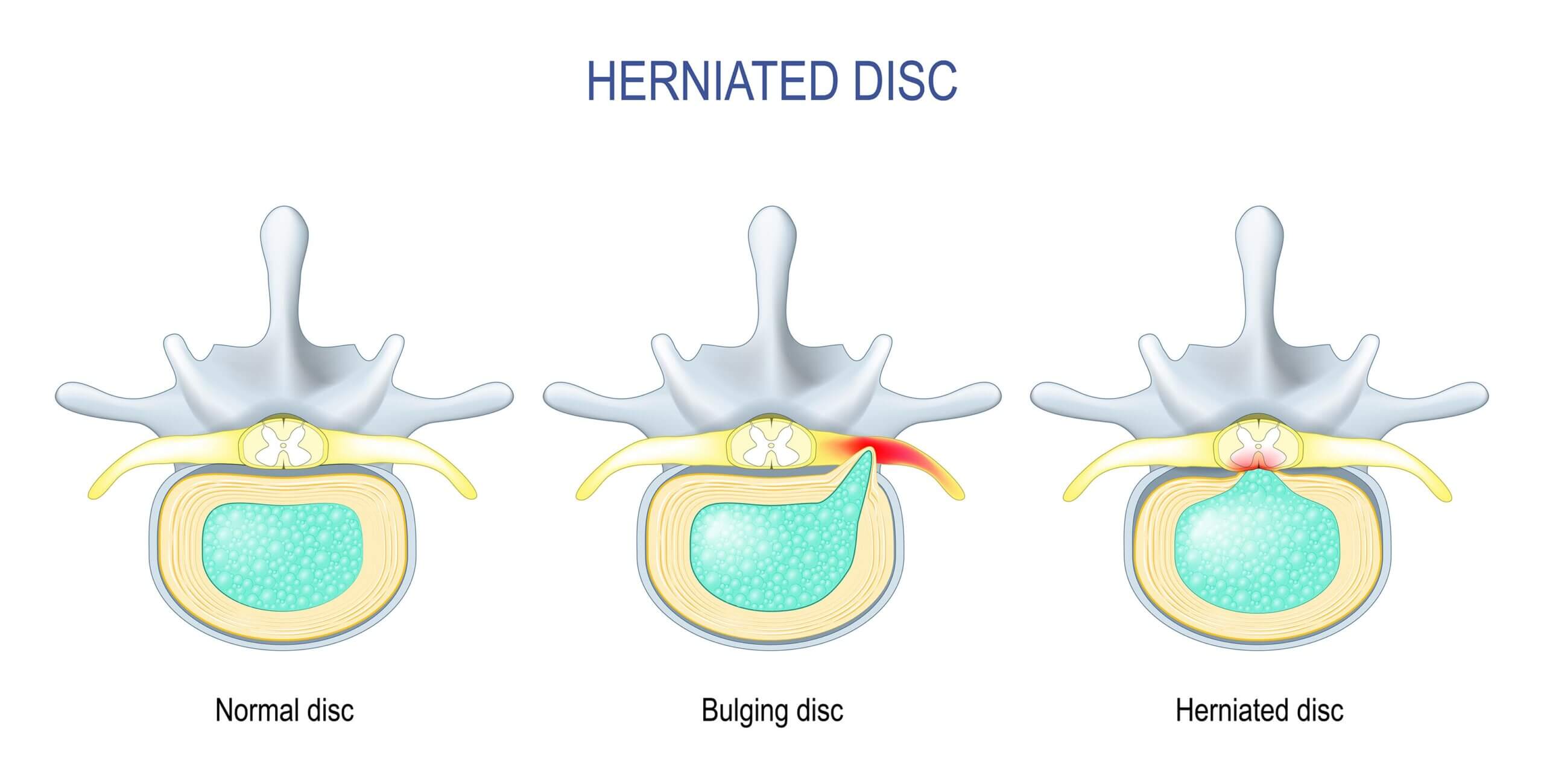 Bulging spinal disc compressing nerve with non-surgical treatment options illustrated