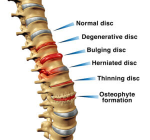 degenerative disc disease spine diagram showing disc height loss