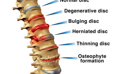 Degenerative Disc Disease Explained