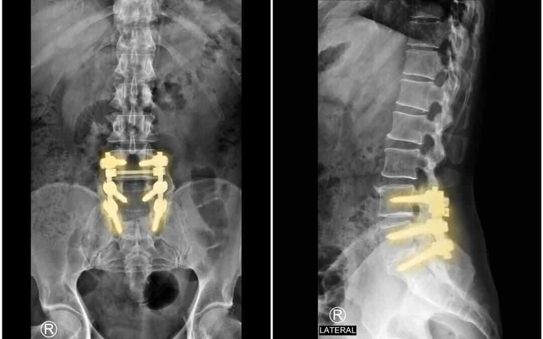Failed Back Surgery Options
