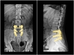 Treatment options for failed back surgery including conservative care revision surgery and non surgical decompression