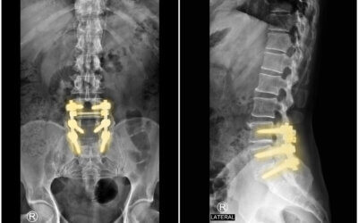 Treatment options for failed back surgery including conservative care revision surgery and non surgical decompression
