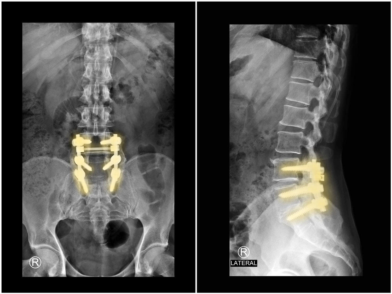 Treatment options for failed back surgery including conservative care revision surgery and non surgical decompression